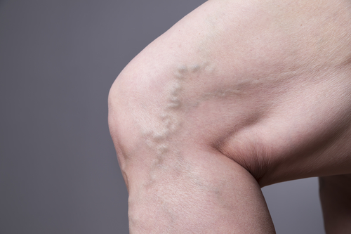 Varicose veins closeup female legs on a gray background