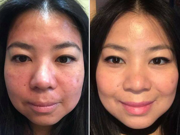 before and after prp facial