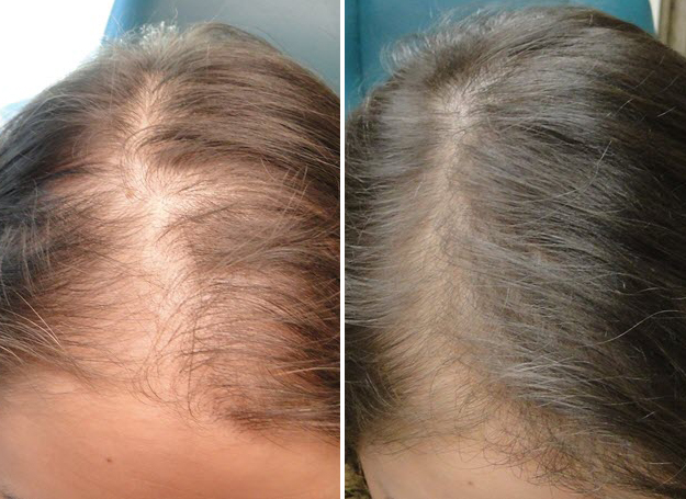 before and after prp hair restoration