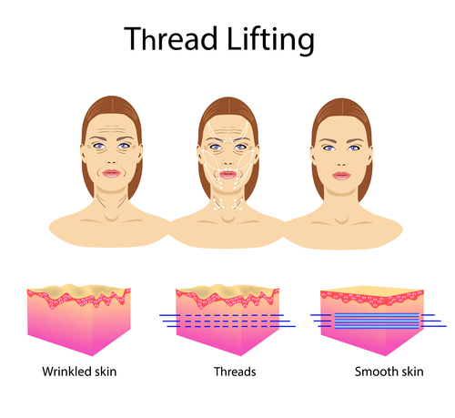 Yes, Silhouette Thread Lifts REALLY Work and Here's How | Hinsdale Vein &  Laser