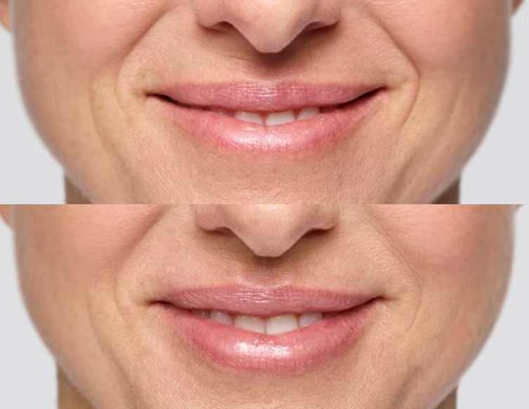 before and after Hinsdale lip filler