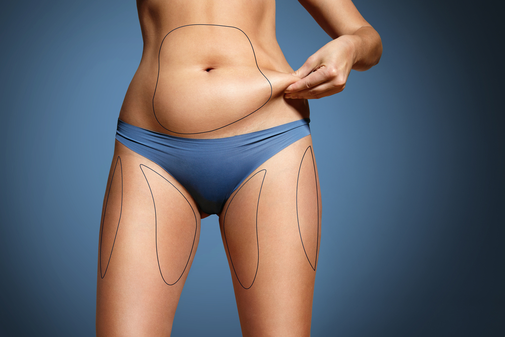 8 Proven Liposuction Recovery Tips | Hinsdale Vein & Laser