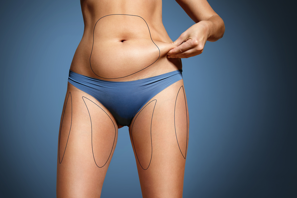 Can 360° Liposuction Prevent Obesity?