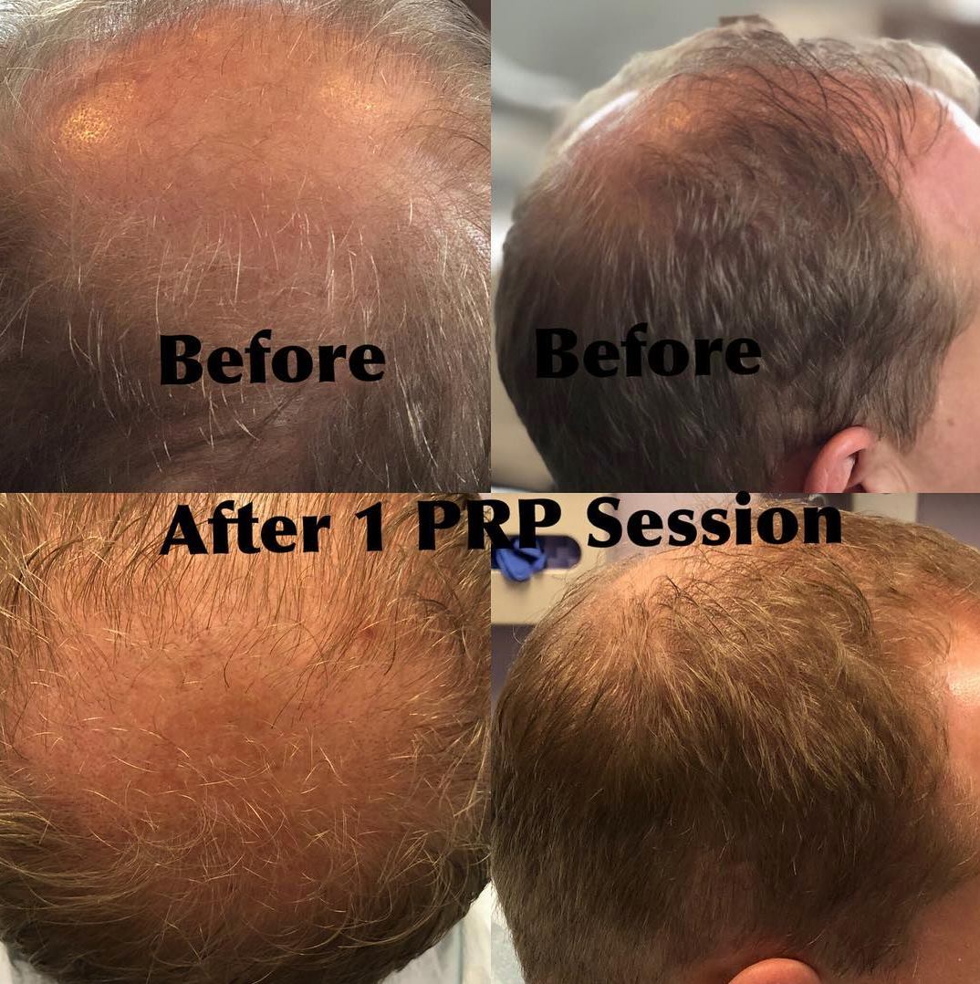 PRP Hair Restoration for Thinning Hair - Hinsdale Vein and Laser