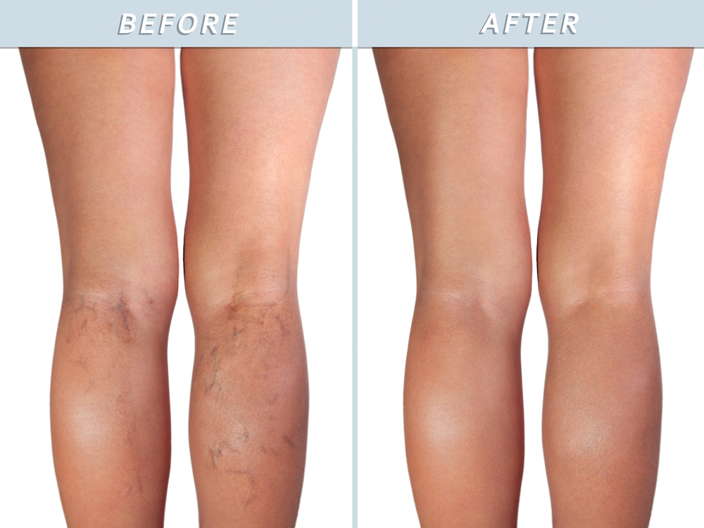 How Much Varicose Vein Treatment Costs Without Insurance