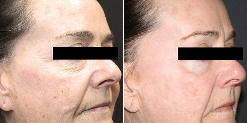 hinsdale tribella before and after
