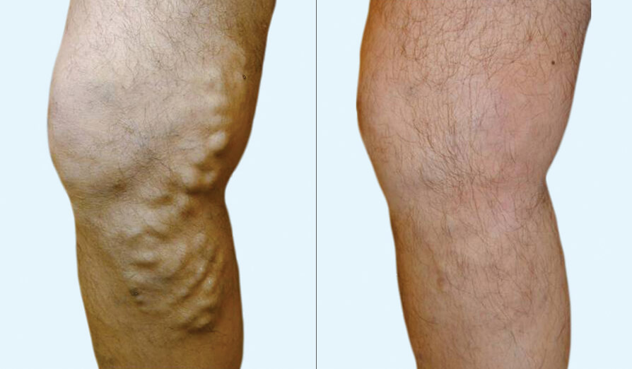 varicose veins before and after laser treatment