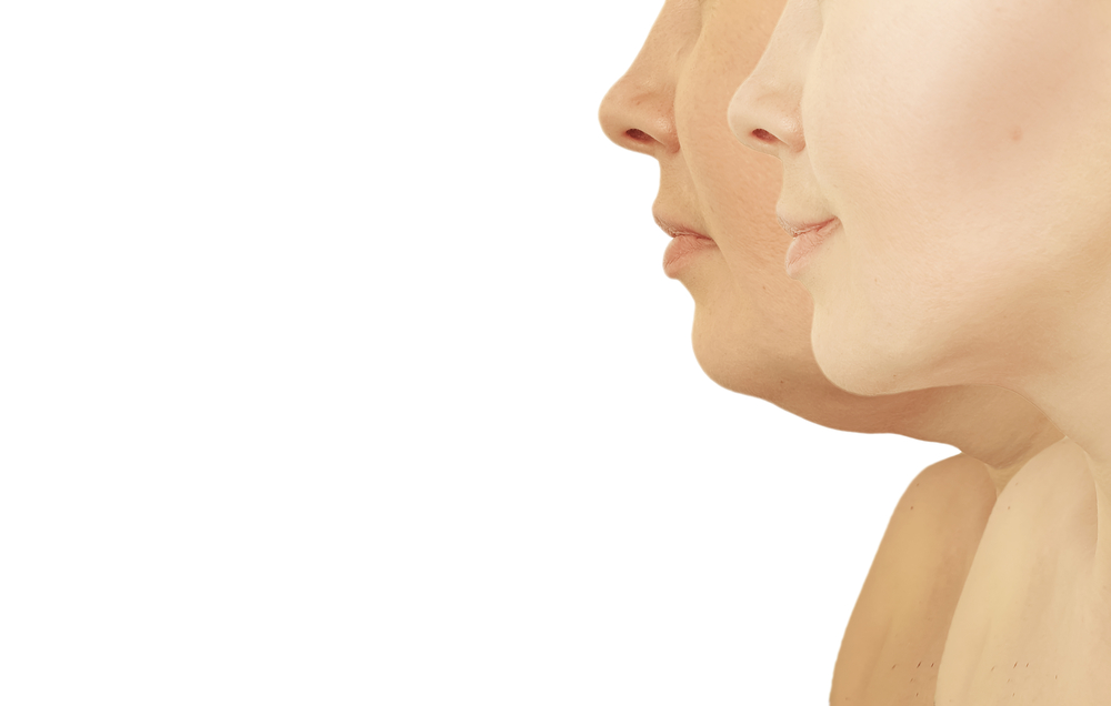 Contour Jawline With Liposuction