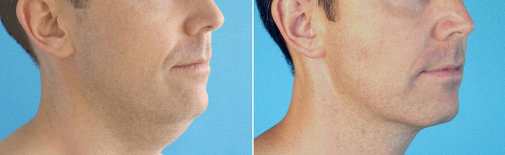 chin lipousction before and after