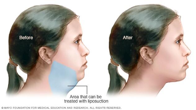 double chin liposuction procedure