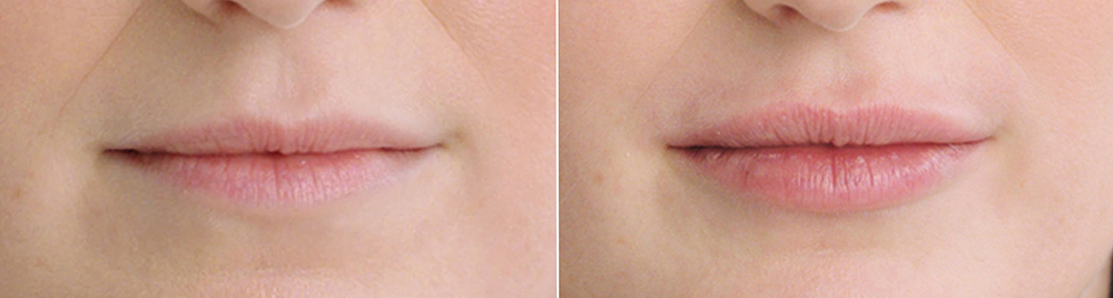 kysse before and after