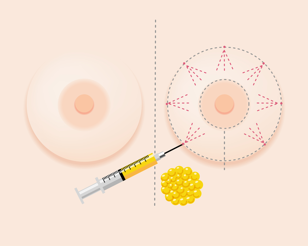 Breast Fat Grafting Treatment
