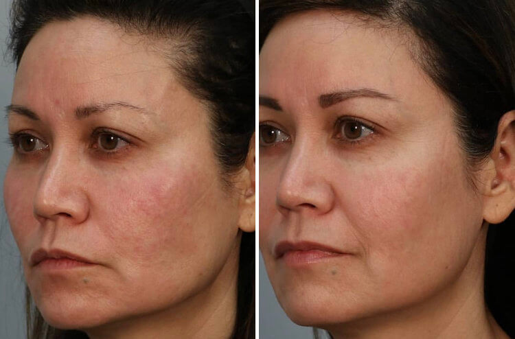 Aquagold Facial Before And After