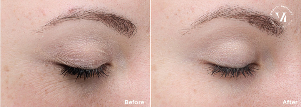 before and after 3 vi peel advanced over 3 months