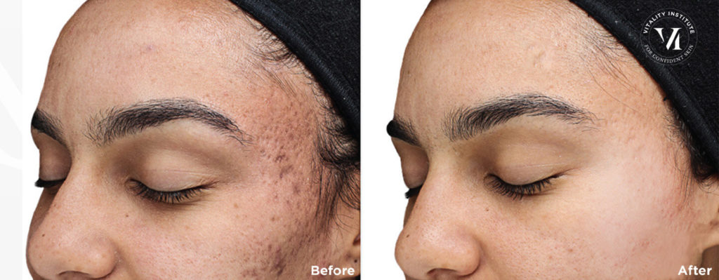 before and after 6 vi peel purify with precision plus over 7 months