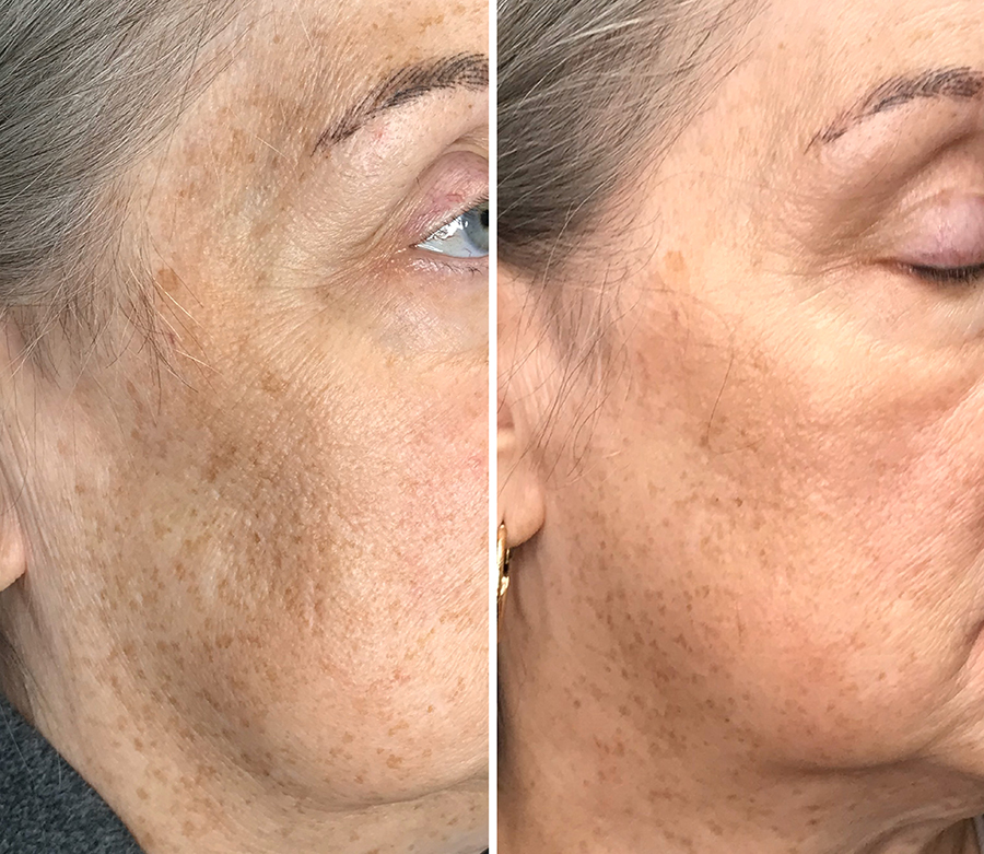 plaxel jowl cheek neck lift before and 12 weeks after