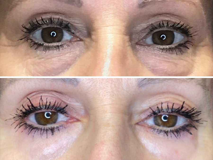 plaxel plasma pen undereyes crow's feet nose wrinkles before and after