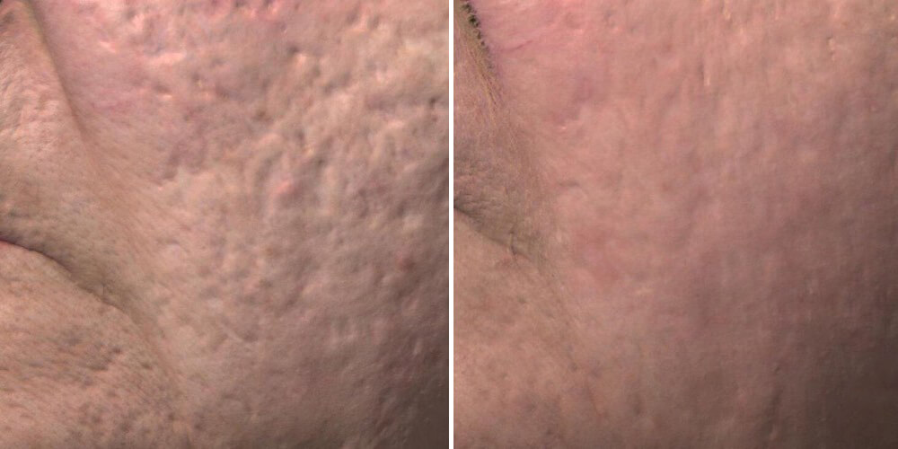 venus viva before and after scarring