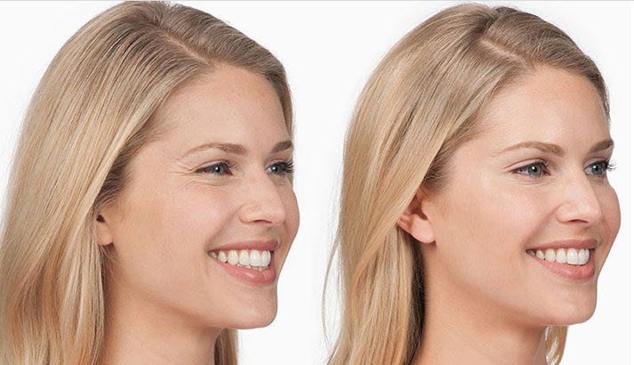 before and after botox for crows feet