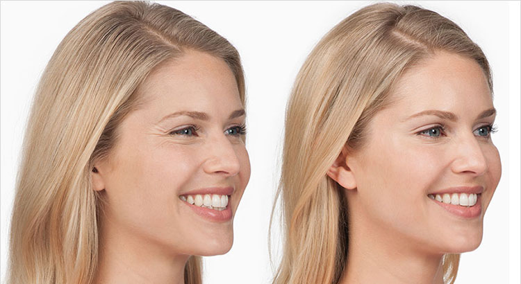 before and after botox for crows feet