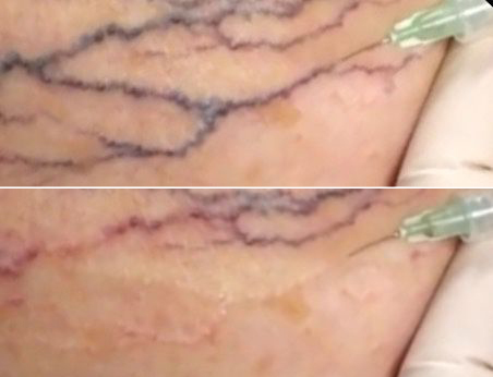 before and after sclerotherapy