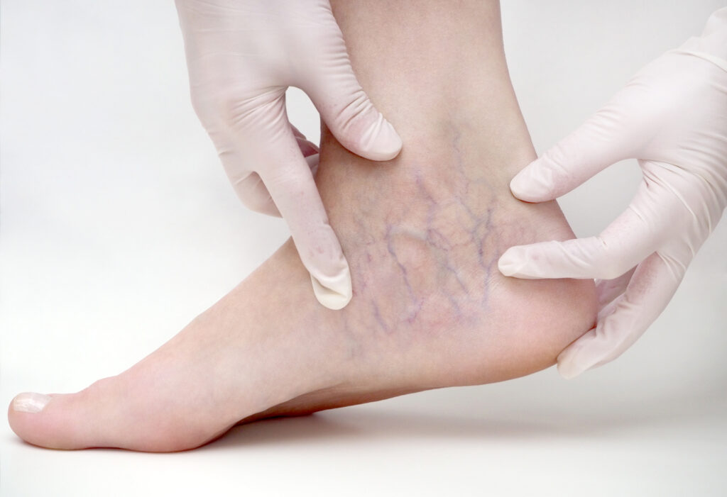 Which Types of Doctors Treat Varicose Veins? - Hinsdale Vein & Laser