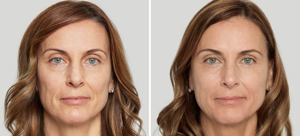 before and after sculptra katherine