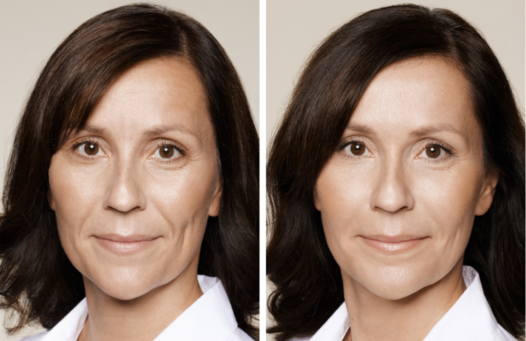 Restylane before and after