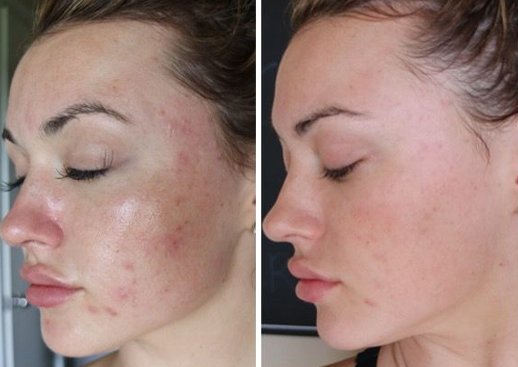 before and after prp facial