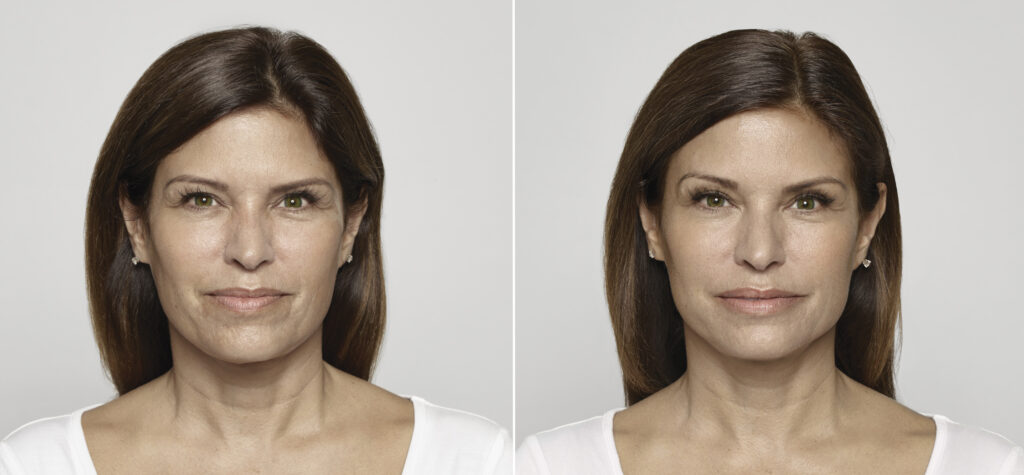 restylane before and after