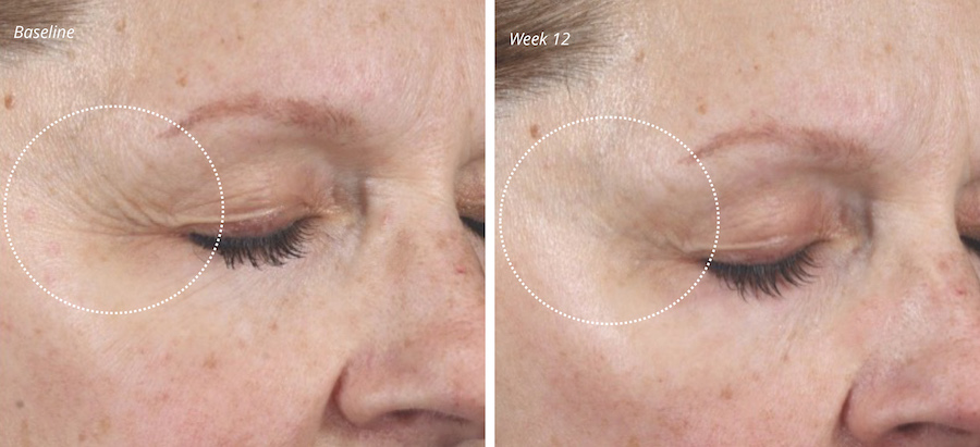 61 yr old patient plated skinscience results on eye wrinkles