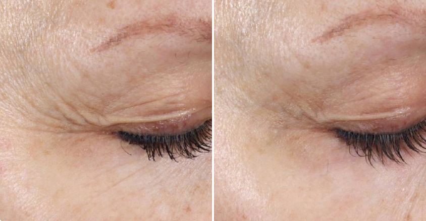 before and after plated skinscience products for wrinkles
