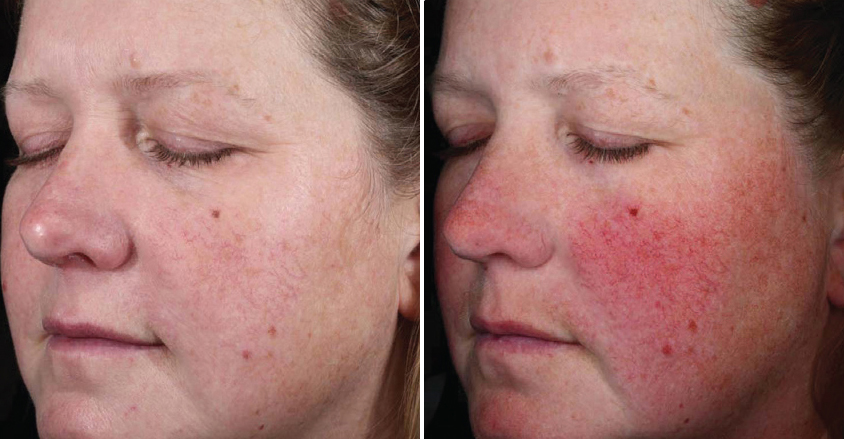 before and after plated skinscience products for redness