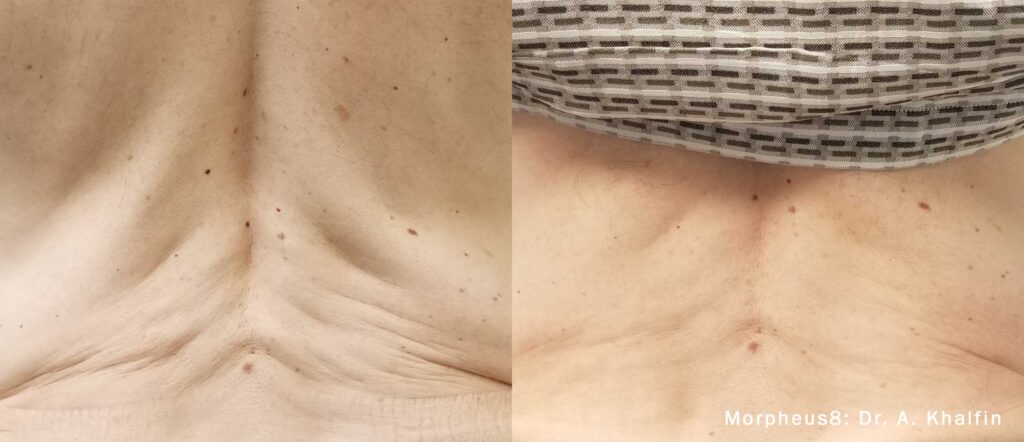 before and after microneedling for the back