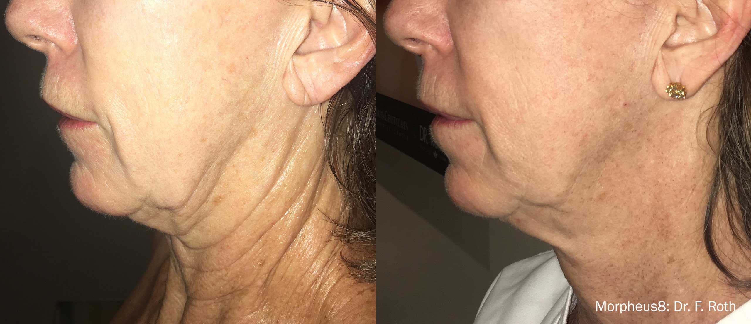 before and after microneedling for the neck