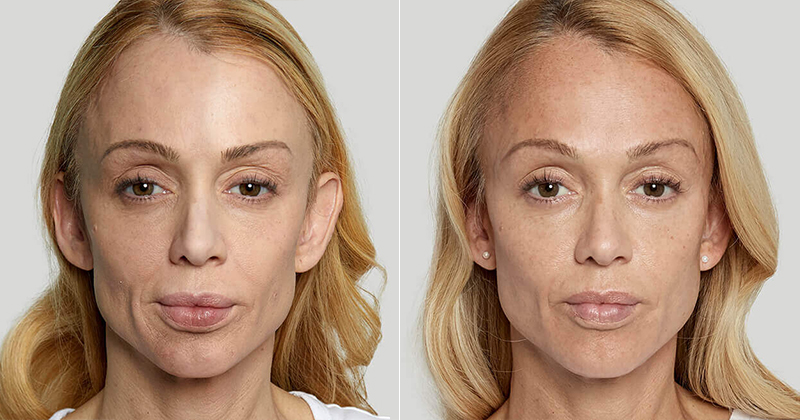 anna before and after sculptra