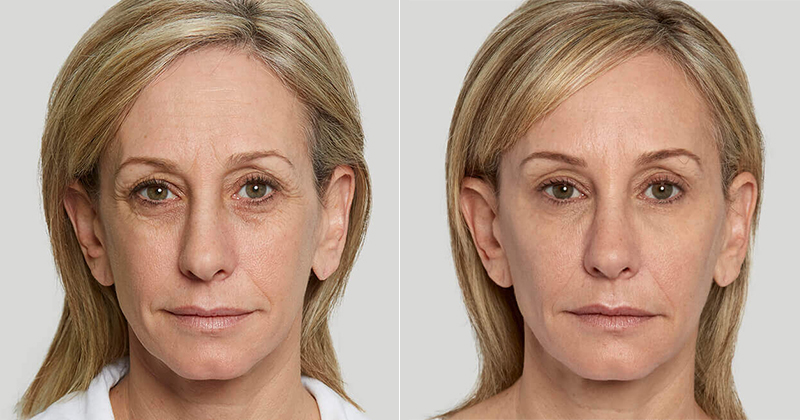 hydi before and after sculptra