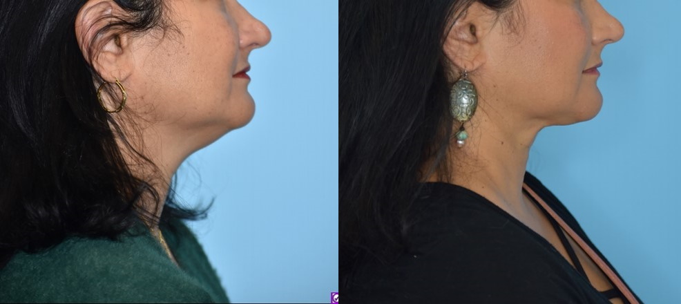 double chin lipo with morpheus8