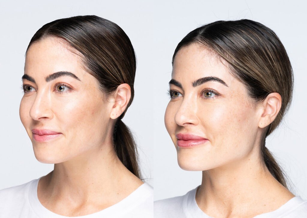 before and after versa lips rachel