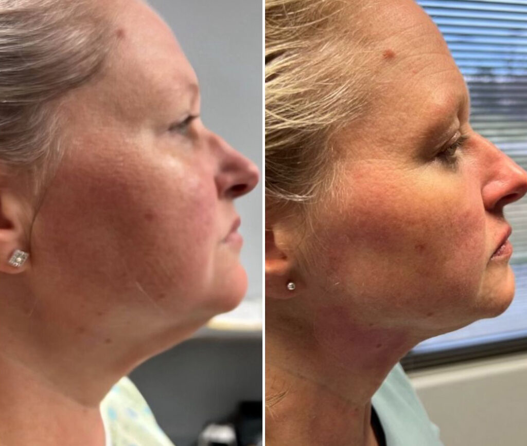 before and after chin lipo dr alkadri