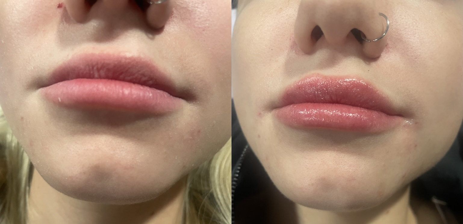 before and after lip filler touchup yvonne