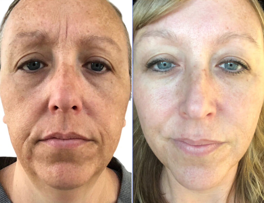 toxbooster peel before and after