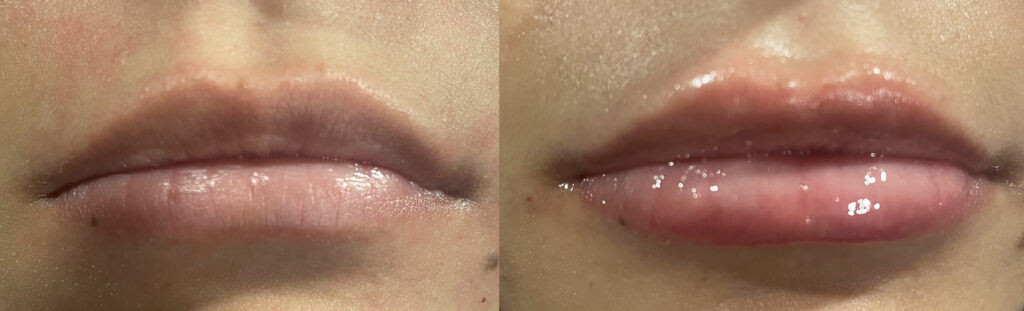 before and after versa lips hvl