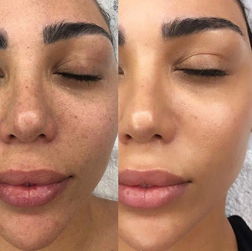 before and after bb glow microneedling