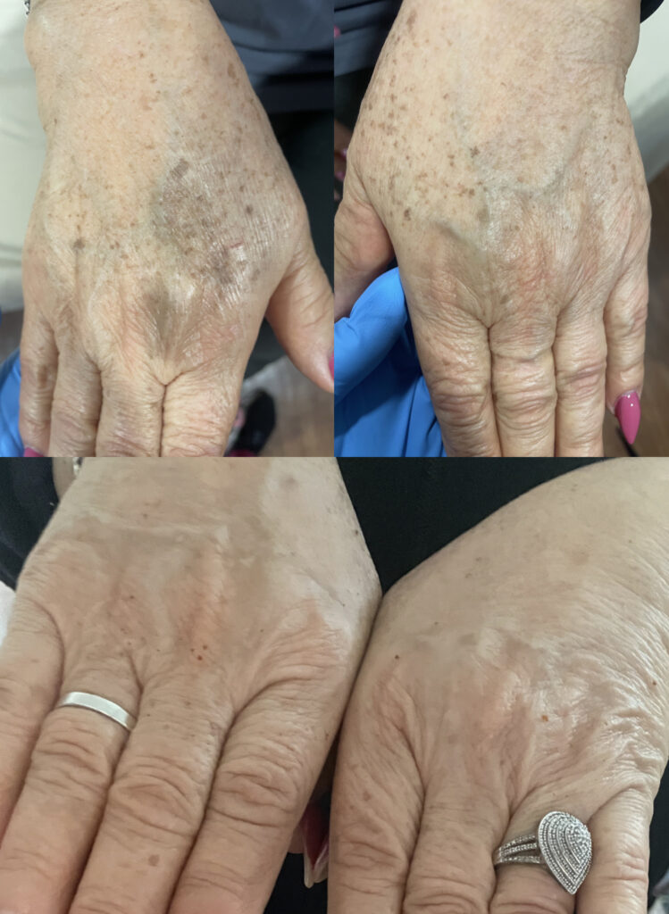 before and after IPL for the hands