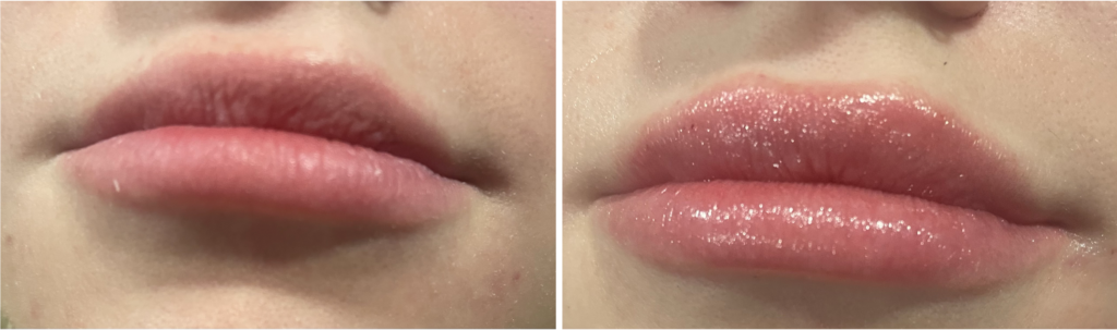 restylane kysse before and after yvonne