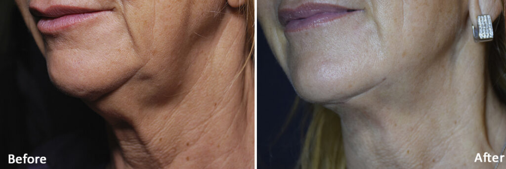 morpheus8 lower face neck before and after
