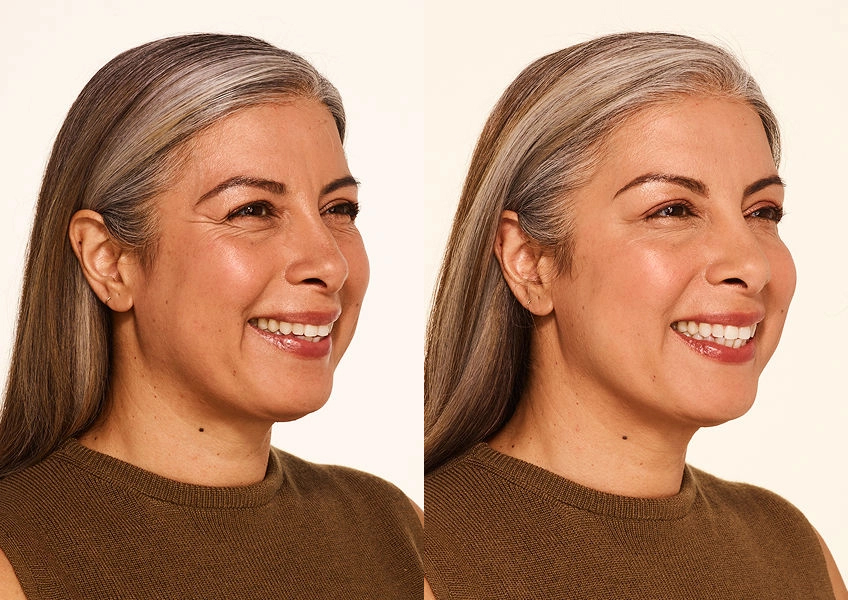 delfina before and after botox