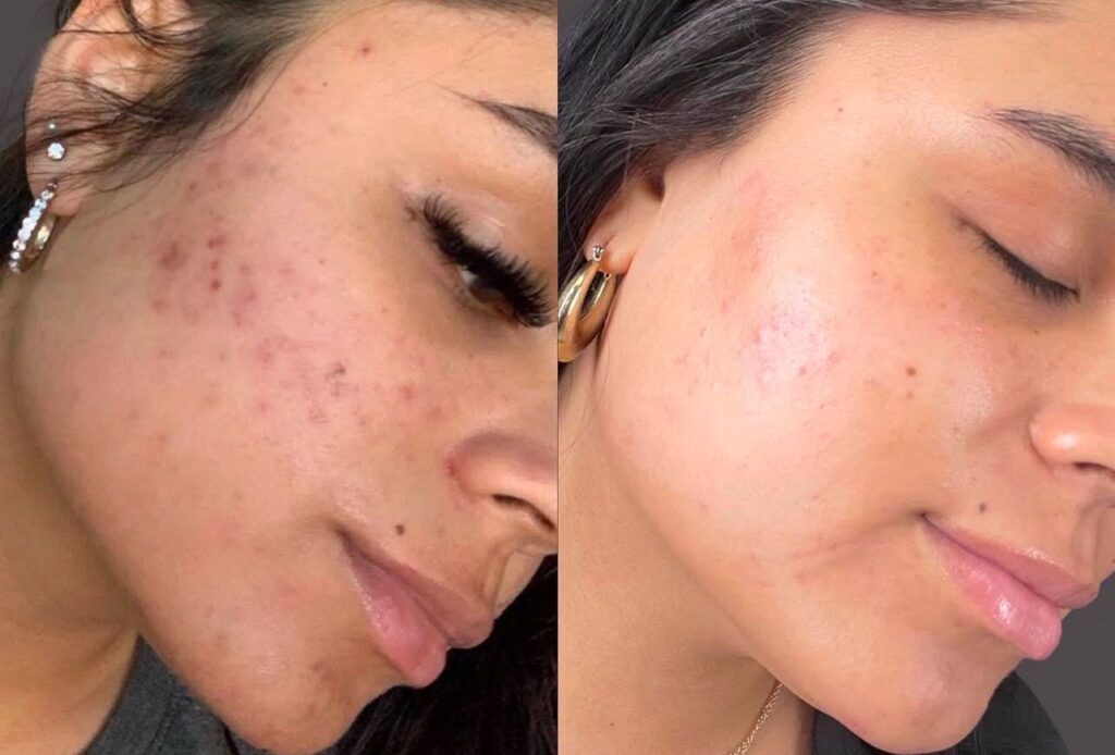 prp microneedling results