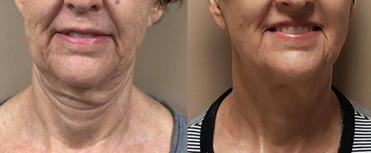 before and after morpheus face and neck